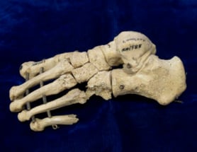 Photograph of skeletal remains of Christopher McNanny's left foot